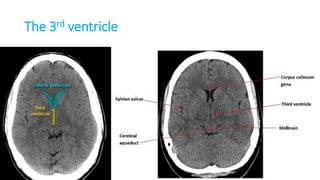 The 3rd ventricle
 