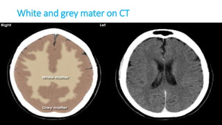 White and grey mater on CT
 