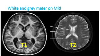 White and grey mater on MRI
T1 T2
 
