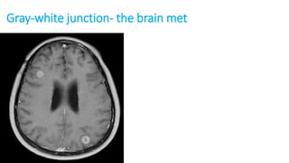 Gray-white junction- the brain met
 
