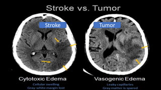 Stroke Tumor
 