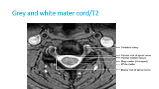 Grey and white mater cord/T2
 