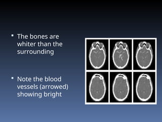  The bones are
whiter than the
surrounding
 Note the blood
vessels (arrowed)
showing bright
 