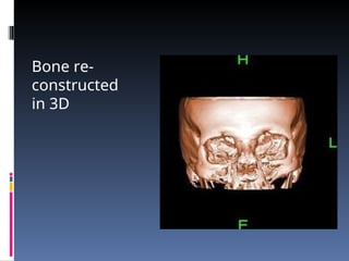 Bone re-
constructed
in 3D
 
