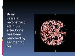 Brain
vessels
reconstruct
ed in 3D
after bone
has been
removed by
segmentati
on
 