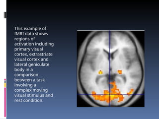 This example of
fMRI data shows
regions of
activation including
primary visual
cortex, extrastriate
visual cortex and
lateral geniculate
body in a
comparison
between a task
involving a
complex moving
visual stimulus and
rest condition.
 