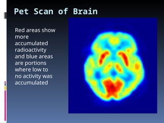 Pet Scan of Brain
Red areas show
more
accumulated
radioactivity
and blue areas
are portions
where low to
no activity was
accumulated
 