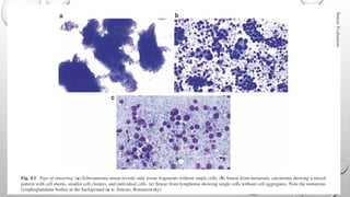 CNS SQUASH SMEAR CYTOLOGY pathology CNS SQUASH SMEAR CYTOLOGY | PPTX