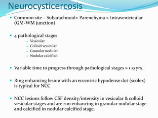Neurocysticercosis
 Common site – Subarachnoid> Parenchyma > Intraventricular
(GM-WM junction)
 4 pathological stages
 Vesicular
 Colloid vesicular
 Granular nodular
 Nodular calcified
 Variable time to progress through pathological stages = 1-9 yrs.
 Ring enhancing lesion with an eccentric hypodense dot (scolex)
is typical for NCC
 NCC lesions follow CSF density/intensity in vesicular & colloid
vesicular stages and are rim enhancing in granular nodular stage
and calcified in nodular calcified stage.
 