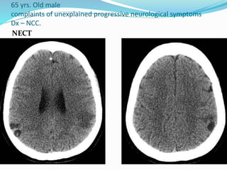 65 yrs. Old male
complaints of unexplained progressive neurological symptoms
Dx – NCC.
NECT
 