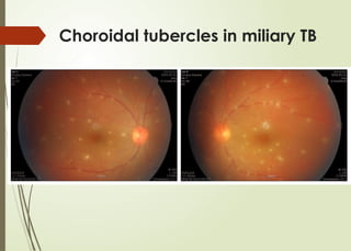 Choroidal tubercles in miliary TB
 