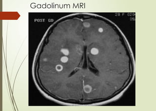 Gadolinum MRI
 