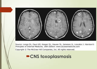 CNS toxoplasmosis
 