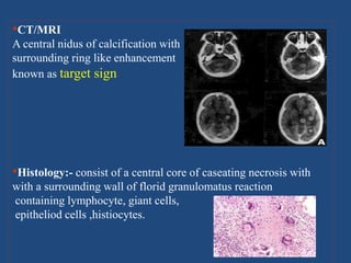 •CT/MRI
A central nidus of calcification with
surrounding ring like enhancement
known as target sign .
•Histology:- consist of a central core of caseating necrosis with
with a surrounding wall of florid granulomatus reaction
containing lymphocyte, giant cells,
epitheliod cells ,histiocytes.
 