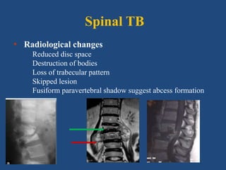 Spinal TB
• Radiological changes
Reduced disc space
Destruction of bodies
Loss of trabecular pattern
Skipped lesion
Fusiform paravertebral shadow suggest abcess formation
 