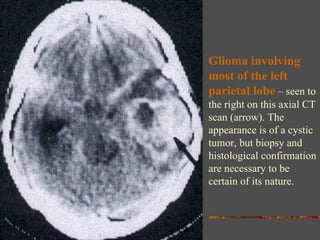 Glioma involving most of the left parietal lobe  – seen to the right on this axial CT scan (arrow). The appearance is of a cystic tumor, but biopsy and histological confirmation are necessary to be certain of its nature. 
