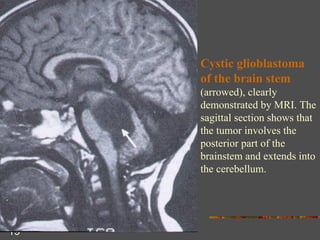Cystic glioblastoma of the brain stem  (arrowed), clearly demonstrated by MRI. The sagittal section shows that the tumor involves the posterior part of the brainstem and extends into the cerebellum. 