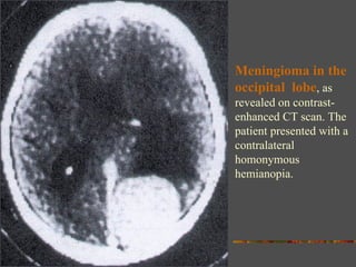 Meningioma in the occipital  lobe , as revealed on contrast-enhanced CT scan. The patient presented with a contralateral homonymous hemianopia. 