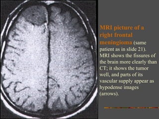 MRI picture of a right frontal meningioma  (same patient as in slide 21). MRI shows the fissures of the brain more clearly than CT; it shows the tumor well, and parts of its vascular supply appear as hypodense images (arrows). 