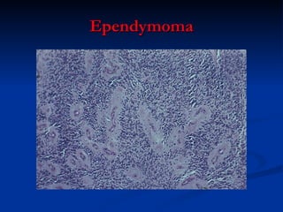 Ependymoma 