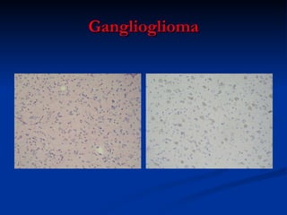 Ganglioglioma 