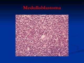 Medulloblastoma 