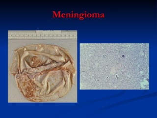 Meningioma 