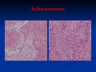Schwannoma 
