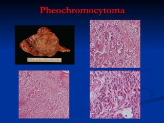 Pheochromocytoma 