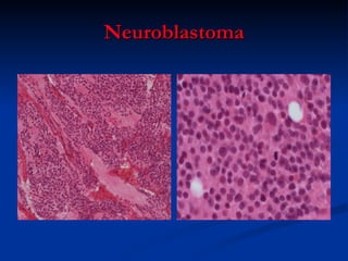 Neuroblastoma 