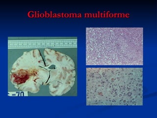 Glioblastoma multiforme 