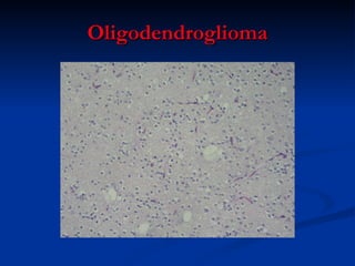 Oligodendroglioma 