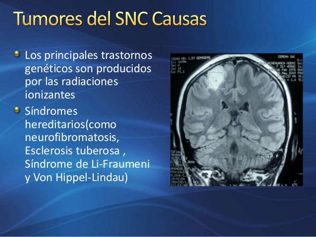 Tumores del Sistema Nervioso Central en Latinoamérica