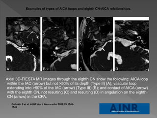 Examples of types of AICA loops and eighth CN-AICA relationships. 
Axial 3D-FIESTA MR images through the eighth CN show the following: AICA loop 
within the IAC (arrow) but not >50% of its depth (Type II) (A); vascular loop 
extending into >50% of the IAC (arrow) (Type III) (B); and contact of AICA (arrow) 
with the eighth CN, not resulting (C) and resulting (D) in angulation on the eighth 
CN (arrow) in the CPA. 
Gultekin S et al. AJNR Am J Neuroradiol 2008;29:1746- 
1749 
 