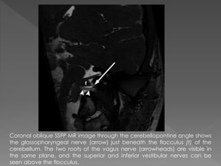 Coronal oblique SSFP MR image through the cerebellopontine angle shows 
the glossopharyngeal nerve (arrow) just beneath the flocculus (f) of the 
cerebellum. The two roots of the vagus nerve (arrowheads) are visible in 
the same plane, and the superior and inferior vestibular nerves can be 
seen above the flocculus. 
 