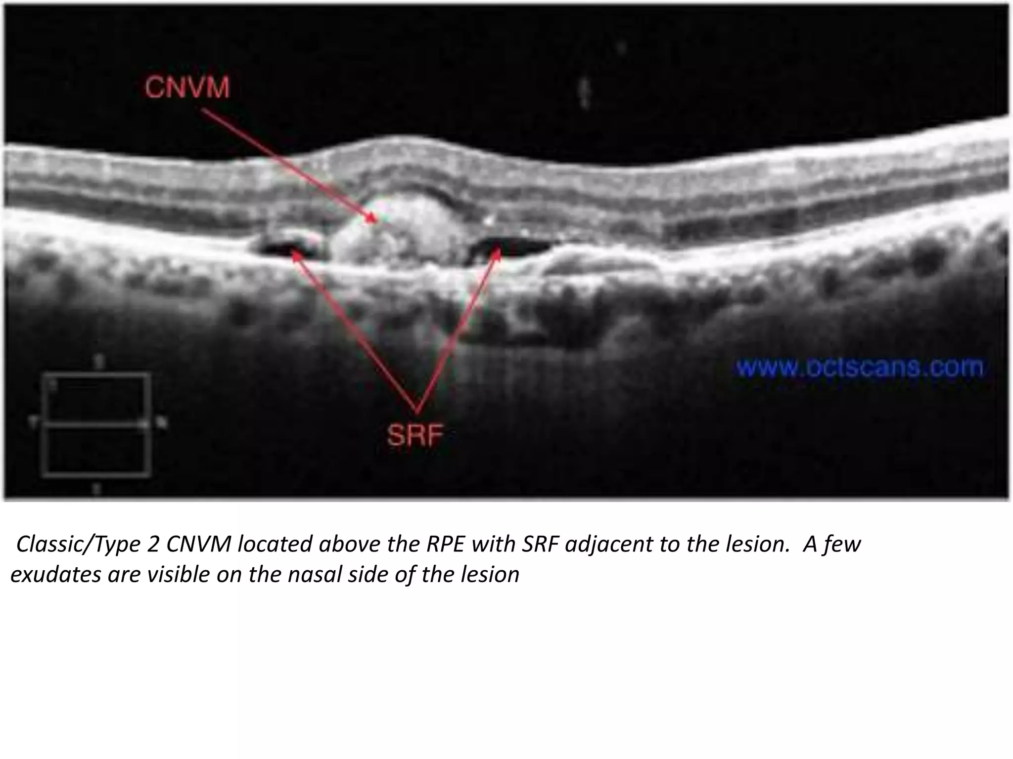Classic/Type 2 CNVM located above the RPE with SRF adjacent to the lesion. A few
exudates are visible on the nasal side of the lesion
 