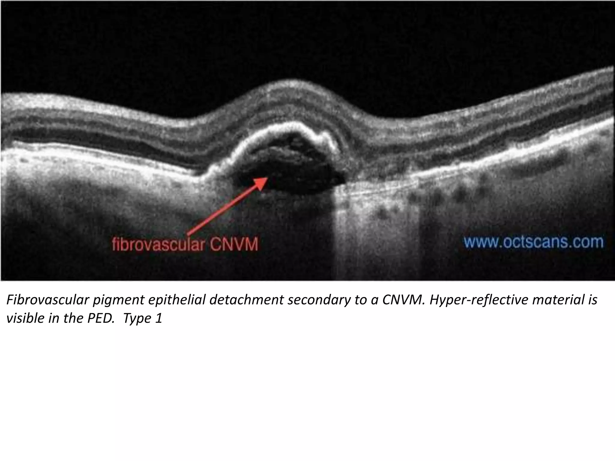 Fibrovascular pigment epithelial detachment secondary to a CNVM. Hyper-reflective material is
visible in the PED. Type 1
 