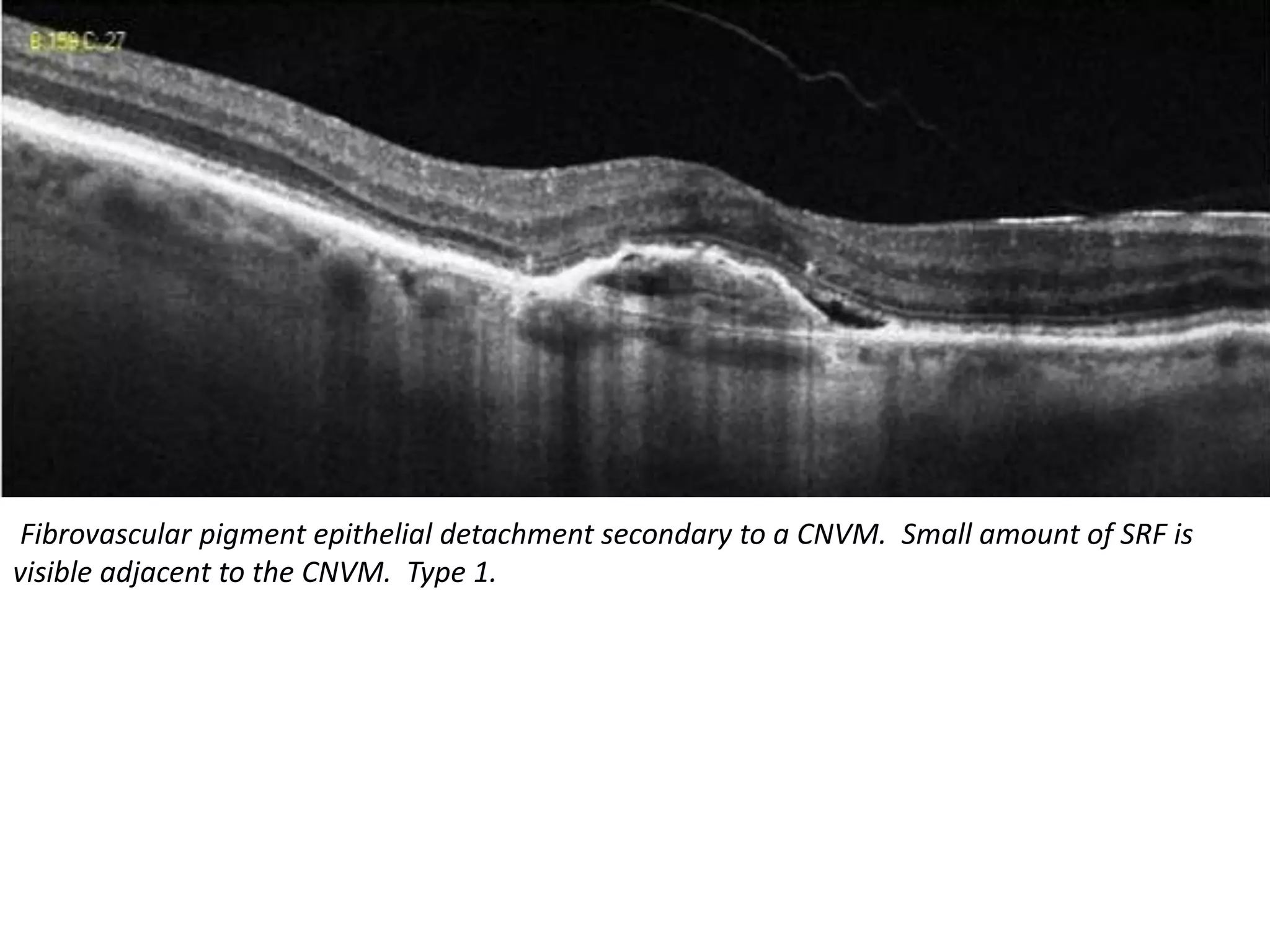 Fibrovascular pigment epithelial detachment secondary to a CNVM. Small amount of SRF is
visible adjacent to the CNVM. Type 1.
 