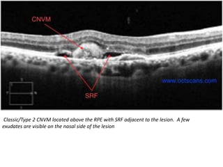 Classic/Type 2 CNVM located above the RPE with SRF adjacent to the lesion. A few
exudates are visible on the nasal side of the lesion
 