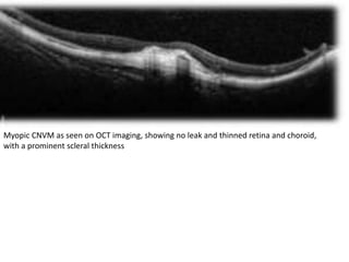 Myopic CNVM as seen on OCT imaging, showing no leak and thinned retina and choroid,
with a prominent scleral thickness
 