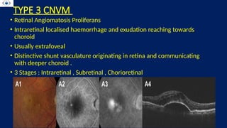 Cnv Types CHOROIDAL NEOVASCULAR MEMBRANE . CNVM . RETINA | PPTX
