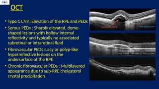 CHOROIDAL NEOVASCULAR MEMBRANE . CNVM . RETINA | PPTX