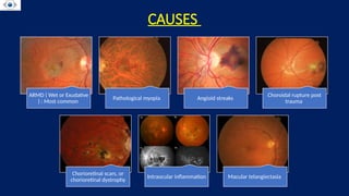 CHOROIDAL NEOVASCULAR MEMBRANE . CNVM . RETINA | PPTX