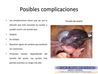 Posibles complicaciones
• Las complicaciones tienen que ver con la
afección que está causando los quistes y
pueden ocurrir con quistes que:
• Sangran.
• Se rompen.
• Muestran signos de cambios que pudieran
ser cancerosos.
• Presentan torsión, dependiendo del
tamaño del quiste. Los quistes más
grandes acarrean un riesgo más alto
Torsión de ovario
 