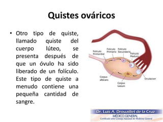 Quistes ováricos
• Otro tipo de quiste,
llamado quiste del
cuerpo lúteo, se
presenta después de
que un óvulo ha sido
liberado de un folículo.
Este tipo de quiste a
menudo contiene una
pequeña cantidad de
sangre.
 