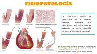 FISIOPATOLOGÍA
La contusión severa se
caracteriza por a necrosis
irregular, asociada con
hemorragia epicárdica que se
extiende en forma piramidal
intramural o incluso transmural
Mattox, Moore, Feliciano. Trauma, Chap 28. McGraw-Hill 2006
Raja AS. Thoracic trauma. In: Walls RM, Hockberger RS, Gausche-Hill M, eds.
Rosen's Emergency Medicine: Concepts and Clinical Practice. 9th ed.
Philadelphia, PA: Elsevier; 2018:chap 38
 