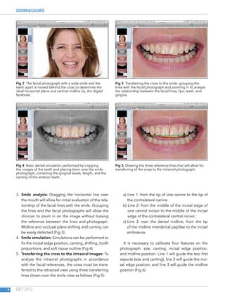 COACHMAN/CALAMITA
QDT 20124
3.  Smile analysis: Dragging the horizontal line over
the mouth will allow for initial evaluation of the rela-
tionship of the facial lines with the smile. Grouping
the lines and the facial photographs will allow the
clinician to zoom in on the image without loosing
the reference between the lines and photograph.
Midline and occlusal plane shifting and canting can
be easily detected (Fig 3).
4.  Smile simulation: Simulations can be performed to
fix the incisal edge position, canting, shifting, tooth
proportions, and soft tissue outline (Fig 4).
5.  Transferring the cross to the intraoral images: To
analyze the intraoral photographs in accordance
with the facial references, the cross must be trans-
ferred to the retracted view using three transferring
lines drawn over the smile view as follows (Fig 5):
a) Line 1: from the tip of one canine to the tip of
the contralateral canine.
b) Line 2: from the middle of the incisal edge of
one central incisor to the middle of the incisal
edge of the contralateral central incisor.
c) Line 3: over the dental midline, from the tip
of the midline interdental papillae to the incisal
embrasure.
 It is necessary to calibrate four features on the
photograph: size, canting, incisal edge position,
and midline position. Line 1 will guide the two first
aspects (size and canting), line 2 will guide the inci-
sal edge position, and line 3 will guide the midline
position (Fig 6).
Fig 2  The facial photograph with a wide smile and the
teeth apart is moved behind the cross to determine the
ideal horizontal plane and vertical midline (ie, the digital
facebow).
Fig 4  Basic dental simulation performed by cropping
the images of the teeth and placing them over the smile
photograph, correcting the gingival levels, length, and the
canting of the anterior teeth.
Fig 3  Transferring the cross to the smile: grouping the
lines with the facial photograph and zooming in to analyze
the relationship between the facial lines, lips, teeth, and
gingiva.
Fig 5  Drawing the three reference lines that will allow for
transferring of the cross to the intraoral photograph.
 