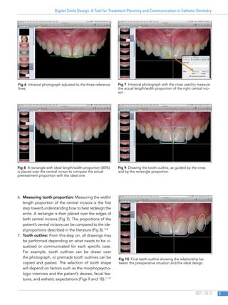 Digital Smile Design: A Tool for Treatment Planning and Communication in Esthetic Dentistry
QDT 2012 5
6.  Measuring tooth proportion: Measuring the width/
length proportion of the central incisors is the first
step toward understanding how to best redesign the
smile. A rectangle is then placed over the edges of
both central incisors (Fig 7). The proportions of the
patient’s central incisors can be compared to the ide-
al proportions described in the literature (Fig 8).2–8
7.  Tooth outline: From this step on, all drawings may
be performed depending on what needs to be vi-
sualized or communicated for each specific case.
For example, tooth outlines can be drawn over
the photograph, or premade tooth outlines can be
copied and pasted. The selection of tooth shape
will depend on factors such as the morphopsycho-
logic interview and the patient’s desires, facial fea-
tures, and esthetic expectations (Figs 9 and 10).11,13
Fig 6  Intraoral photograph adjusted to the three reference
lines.
Fig 8  A rectangle with ideal length/width proportion (80%)
is placed over the central incisor to compare the actual
pretreatment proportion with the ideal one.
Fig 7  Intraoral photograph with the cross used to measure
the actual length/width proportion of the right central inci-
sor.
Fig 9  Drawing the tooth outline, as guided by the cross
and by the rectangle proportion.
Fig 10  Final teeth outline showing the relationship be-
tween the preoperative situation and the ideal design.
 