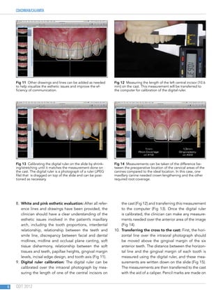 COACHMAN/CALAMITA
QDT 20126
8.  White and pink esthetic evaluation: After all refer-
ence lines and drawings have been provided, the
clinician should have a clear understanding of the
esthetic issues involved in the patient’s maxillary
arch, including the tooth proportions, interdental
relationship, relationship between the teeth and
smile line, discrepancy between facial and dental
midlines, midline and occlusal plane canting, soft
tissue disharmony, relationship between the soft
tissues and teeth, papillae heights, gingival margin
levels, incisal edge design, and tooth axis (Fig 11).
9.  Digital ruler calibration: The digital ruler can be
calibrated over the intraoral photograph by mea-
suring the length of one of the central incisors on
the cast (Fig 12) and transferring this measurement
to the computer (Fig 13). Once the digital ruler
is calibrated, the clinician can make any measure-
ments needed over the anterior area of the image
(Fig 14).
10.  Transferring the cross to the cast: First, the hori-
zontal line over the intraoral photograph should
be moved above the gingival margin of the six
anterior teeth. The distance between the horizon-
tal line and the gingival margin of each tooth is
measured using the digital ruler, and these mea-
surements are written down on the slide (Fig 15).
The measurements are then transferred to the cast
with the aid of a caliper. Pencil marks are made on
Fig 11  Other drawings and lines can be added as needed
to help visualize the esthetic issues and improve the ef-
ficiency of communication.
Fig 13  Calibrating the digital ruler on the slide by shrink-
ing/stretching until it matches the measurement done on
the cast. The digital ruler is a photograph of a ruler (JPEG
file) that is dragged on top of the slide and can be posi-
tioned as necessary.
Fig 12  Measuring the length of the left central incisor (10.6
mm) on the cast. This measurement will be transferred to
the computer for calibration of the digital ruler.
Fig 14  Measurements can be taken of the difference be-
tween the preoperative location of the cervical areas of the
canines compared to the ideal location. In this case, one
maxillary canine needed crown lengthening and the other
required root coverage.
 