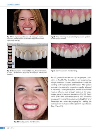COACHMAN/CALAMITA
QDT 20128
the DSD protocol and the wax-up is to perform a clini-
cal try-in (Fig 19). The clinical try-in can be carried out
using a direct mock-up or a provisional restoration de-
pending on the complexity of the case. After patient
approval, the restorative procedures can be adjusted
as necessary. Tooth preparation should be minimally
invasive, allowing just enough clearance to create
proper space for ceramic restorations (Fig 20). Fabri-
cation of the final restorations should be a controlled
process with minimal final adjustments (Fig 21). If all of
these steps are carried out properly and carefully, the
final result will likely exceed the patient’s expectations
(Figs 22 and 23).
Fig 19  Try-in provisional made with bis-acrylic resin is
obtained from a silicone index fabricated on top of the
diagnostic wax-up.
Fig 21  Final ceramic veneers (IPS e.max, Ivoclar Vivadent,
Schaan, Liechtenstein) fabricated according to the silicone
indexes.
Fig 23  Final outcome after 6 months.
Fig 20  Final minimally invasive tooth preparation guided
by the silicone indexes.
Fig 22  Ceramic veneers after bonding.
 